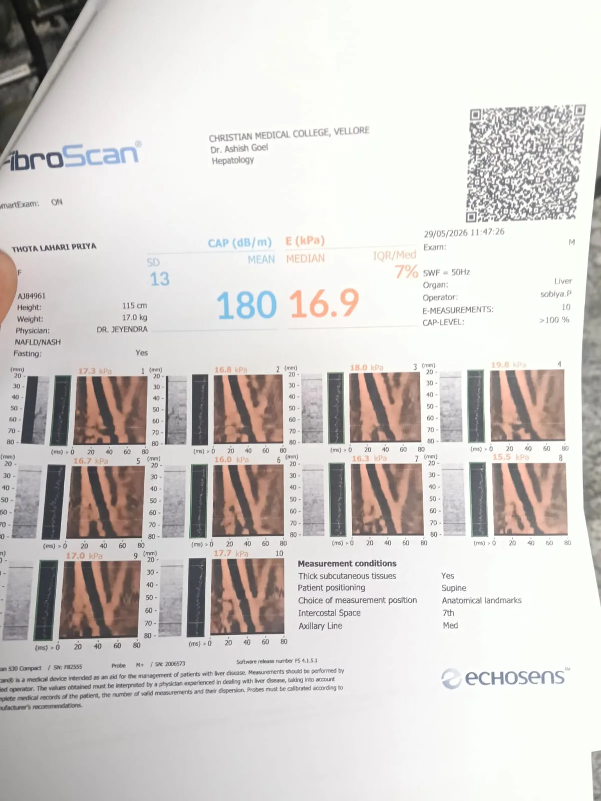 *Offer A Helping Hand To Support THOTA LAHARI PRIYA's Treatment*   Hi, My name is Rambabu Vankudoth and I am raising funds for my friend's family, THOTA LAHARI PRIYA who is suffering from Decompensate